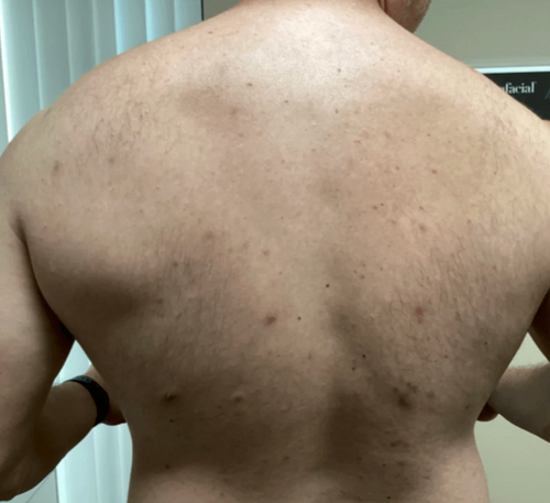 ¡Por fin recuperé la seguridad! Antes me daba una vergüenza tremenda sacarme la remera o que alguien me viera la espalda por culpa de los granos.