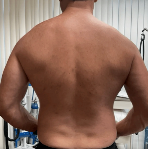 ¡Por fin recuperé la seguridad! Antes me daba una vergüenza tremenda sacarme la remera o que alguien me viera la espalda por culpa de los granos.